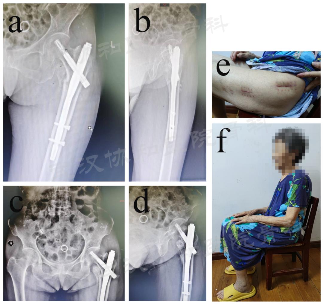 双导牵引矫正器,反向牵引复位固定器