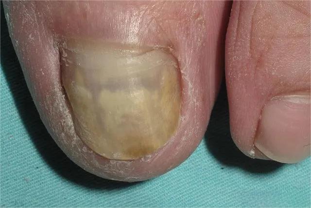 甲癣不严重怎么治疗,甲易生治疗灰指甲吗
