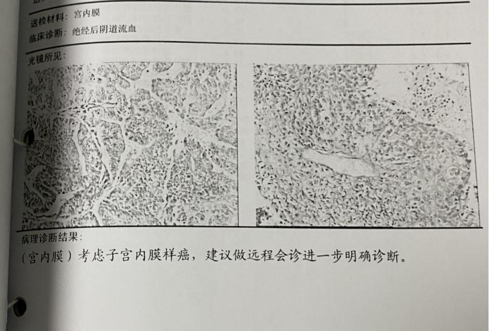 子宫多发肌瘤、宫腔积液、宫颈那囊、盆腔积液，这是什么病？
