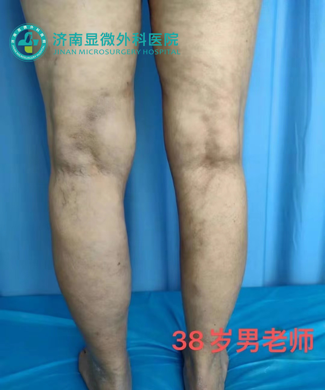 静脉曲张运动疗法的视频,静脉曲张保健手法