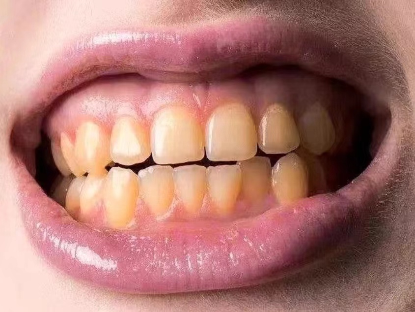 牙科烟渍怎么去除,牙齿烟渍怎么去除最快最有效