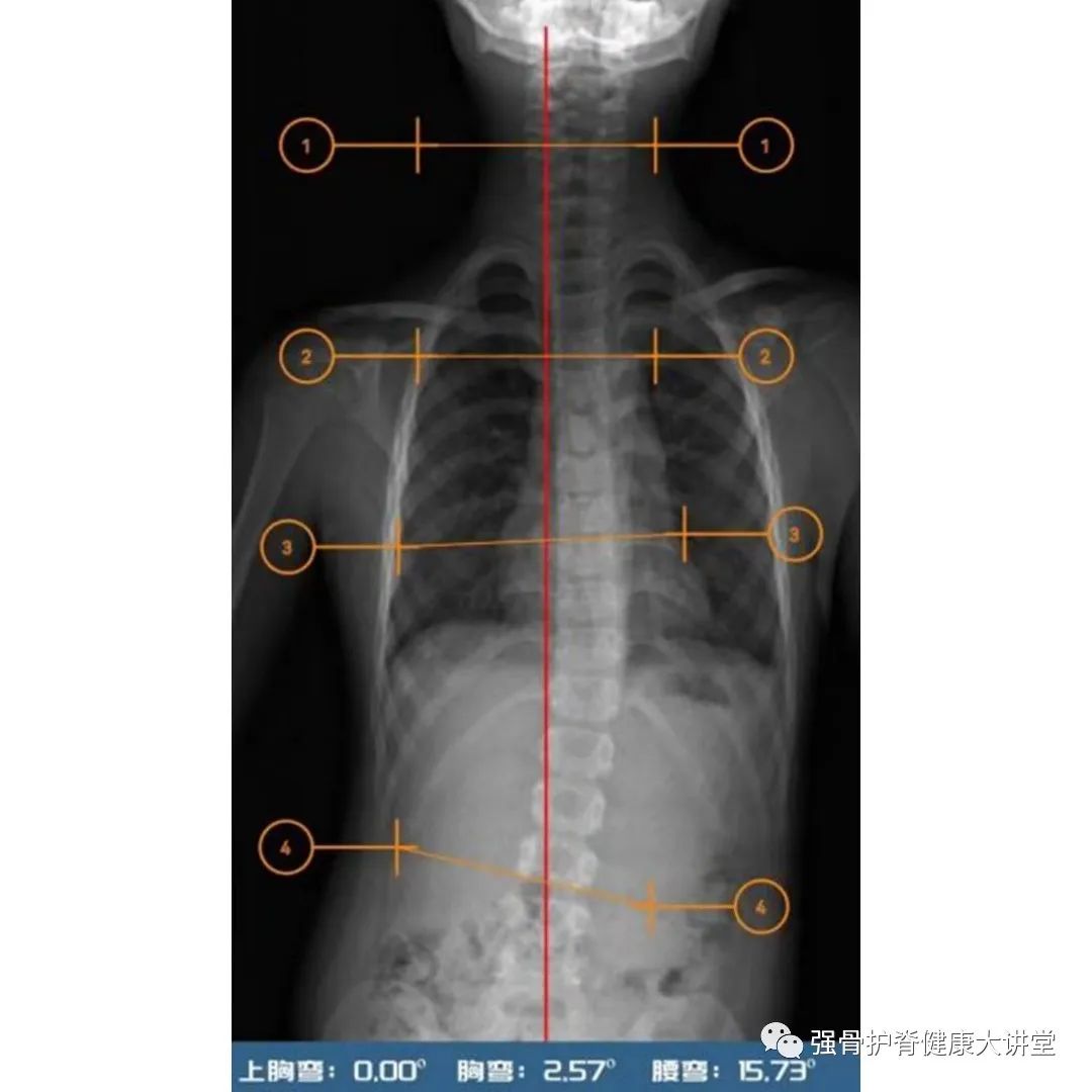 儿童脊柱侧弯治疗图,儿童脊柱侧弯最佳治疗方法