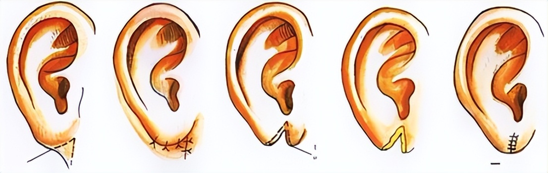 陈国成：为什么会有耳垂裂开？要怎么修复呢？