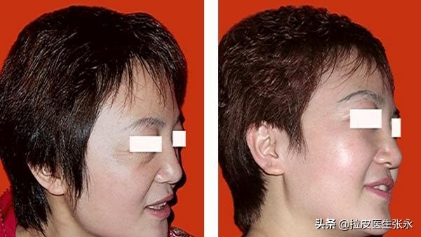 内窥镜小拉皮和传统小拉皮哪个好,拉皮除皱手术真的有效吗