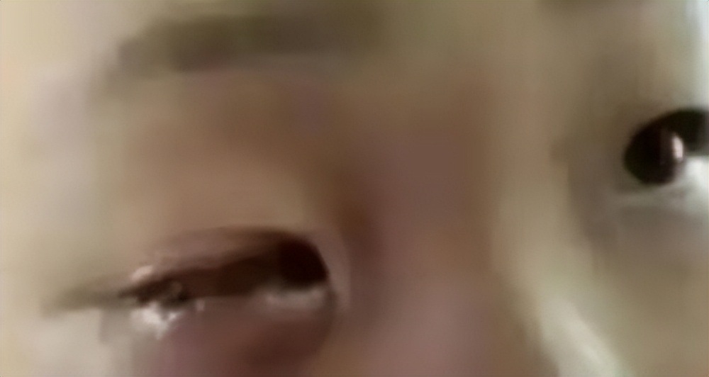 孩子眼球20分钟被熔化,小孩眼珠被熔化了怎么办