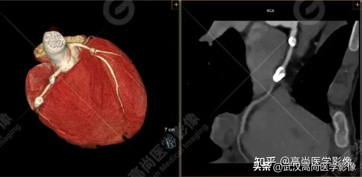 超声心动图可以用来诊断川崎病吗,心脏川崎病cta