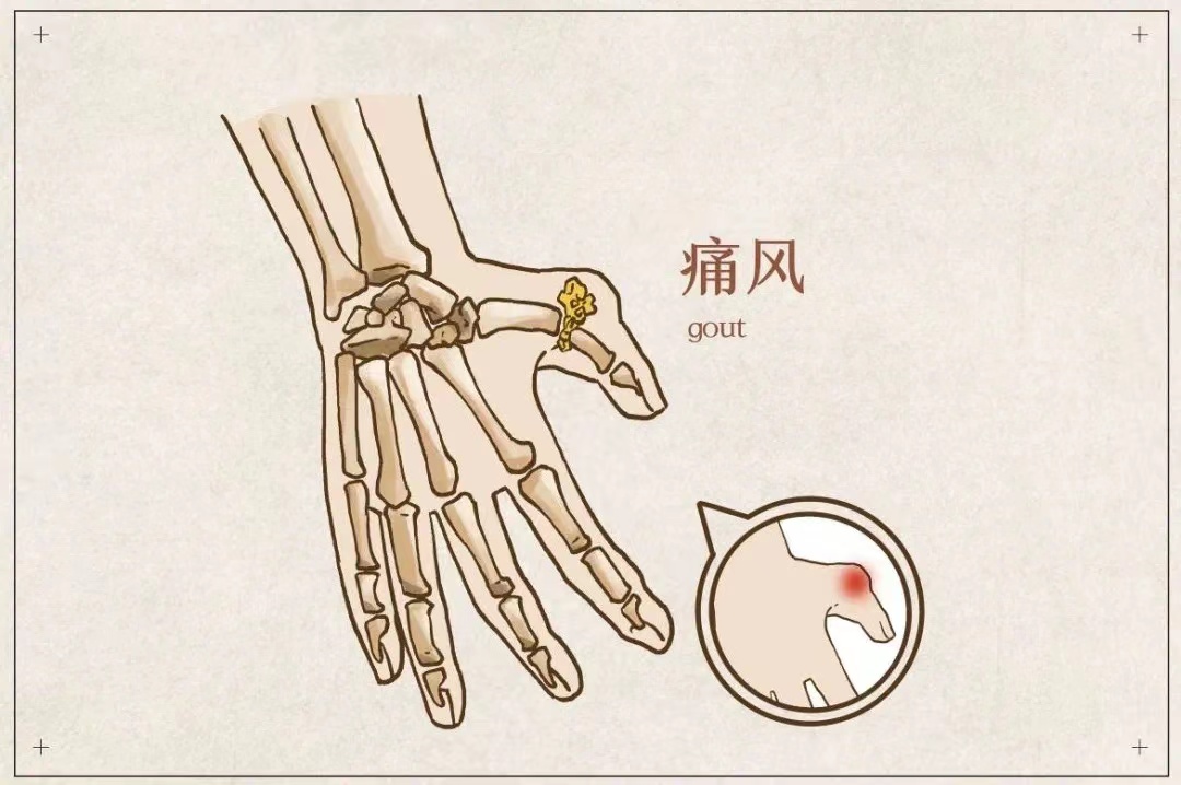 四妙永安汤，让「痛风」不再撕心裂肺