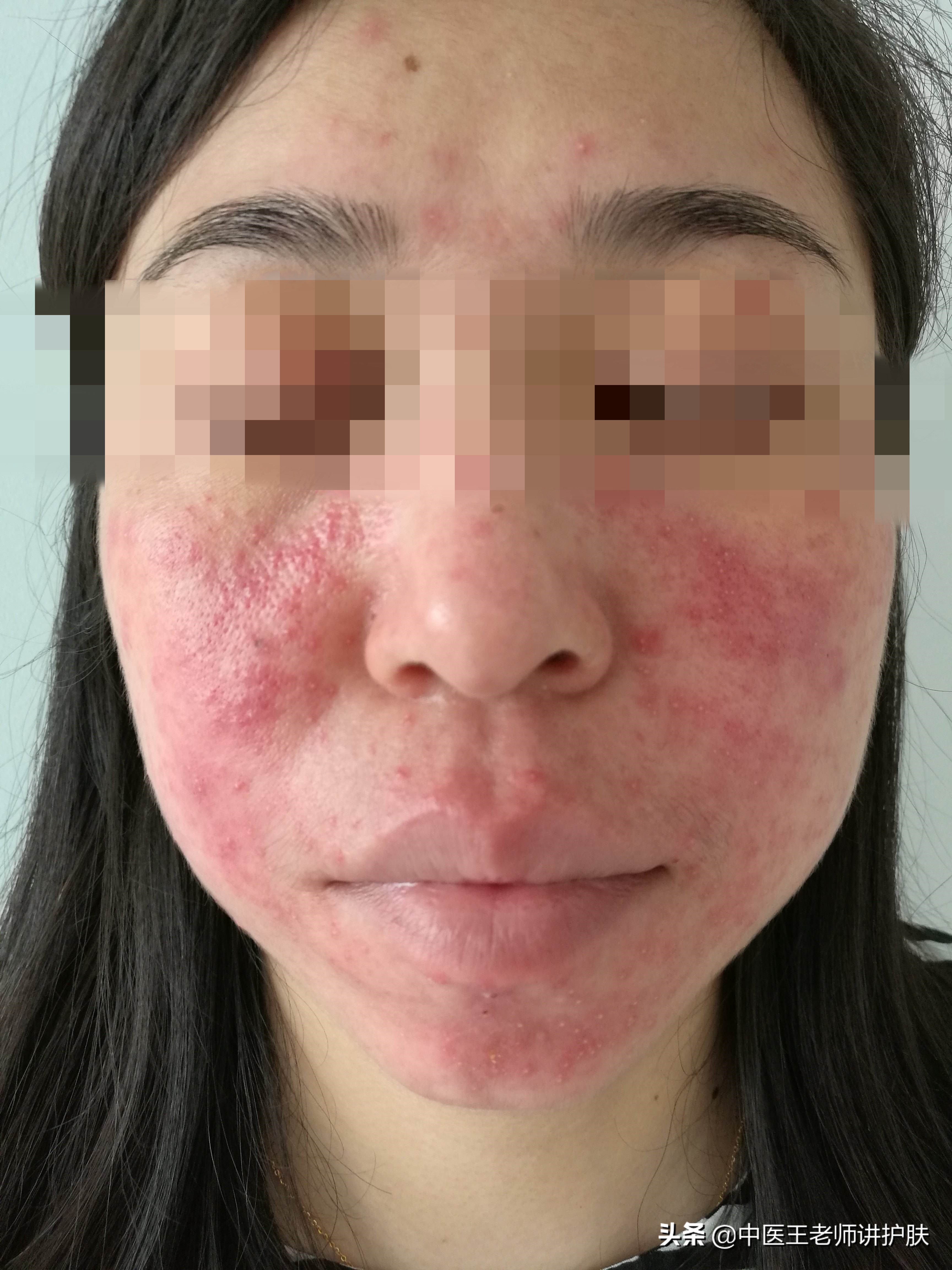 面部激素依赖性皮炎最佳治疗方法,面部激素依赖性皮炎能治好吗