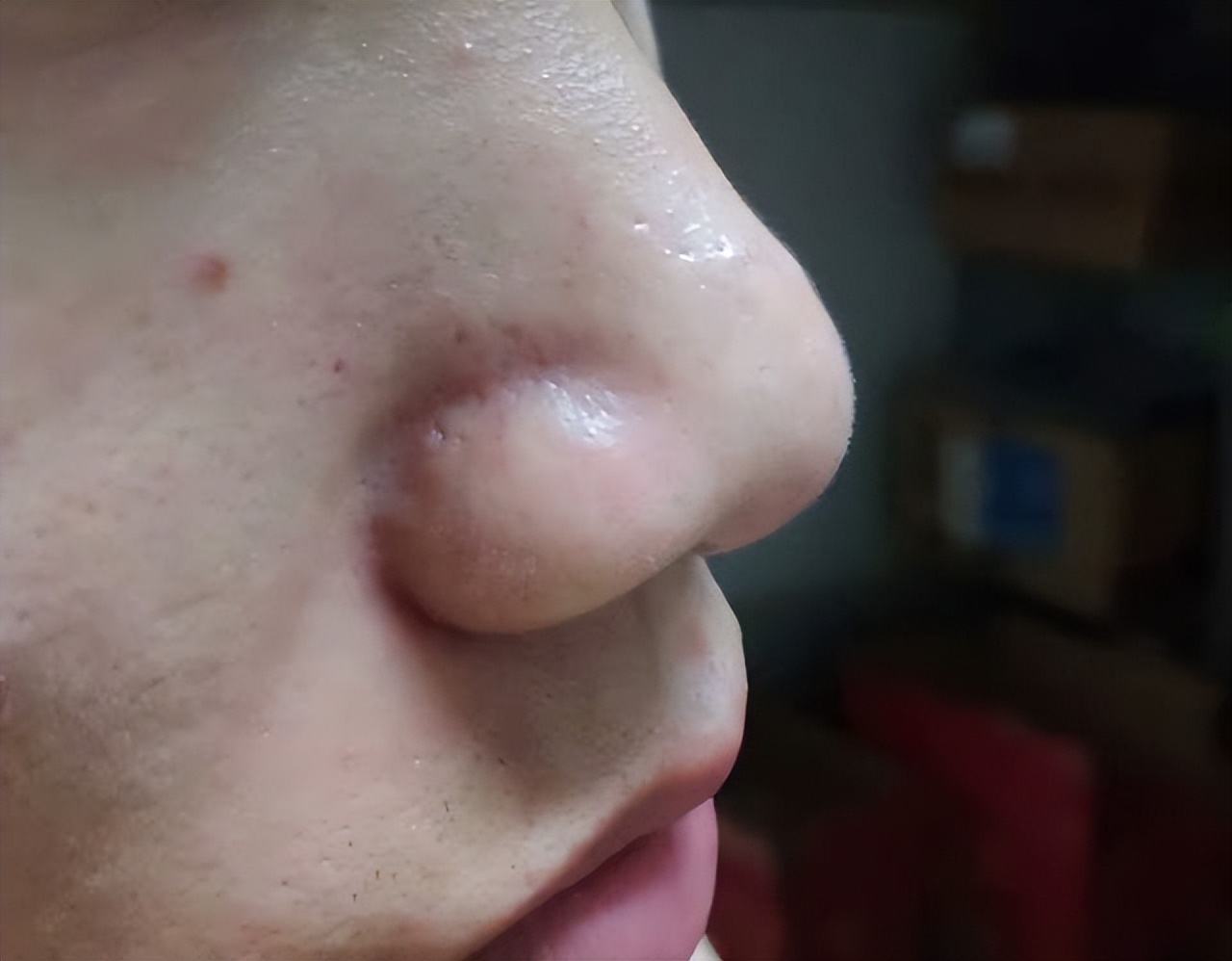 眉心鼻翼和下巴长粉刺为什么,鼻头上起粉刺什么原因引起的图片