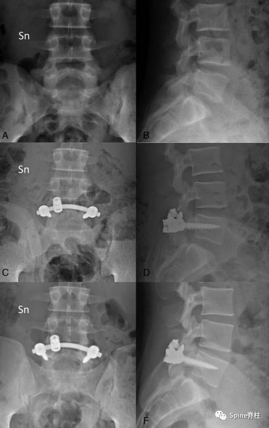 轻度峡部裂和重度峡部裂的区别,真性峡部裂和假性峡部裂