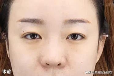 双眼皮术后20天基本不再变化了,挑战双眼皮术后39天做睫毛