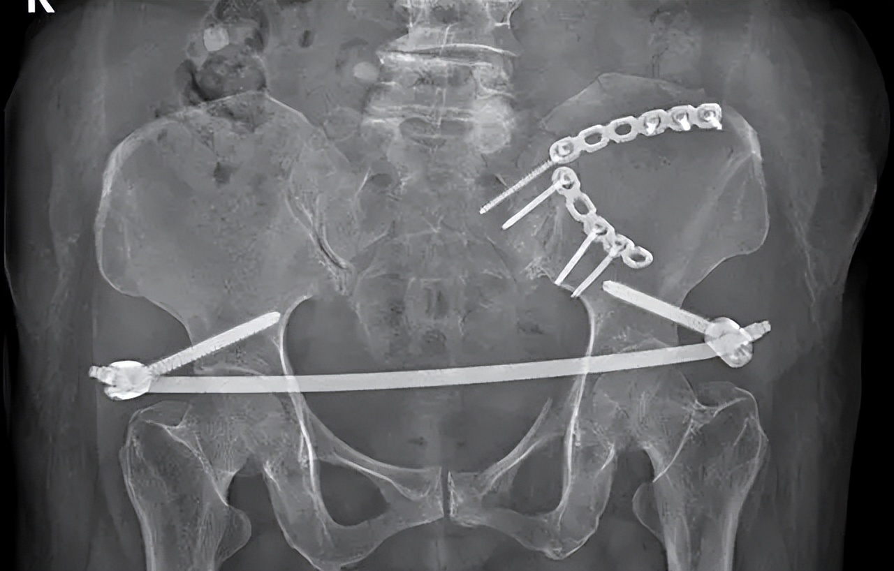 骨盆后环损伤后，新型螺钉的不同内固方法各有何优势？哪种方法好