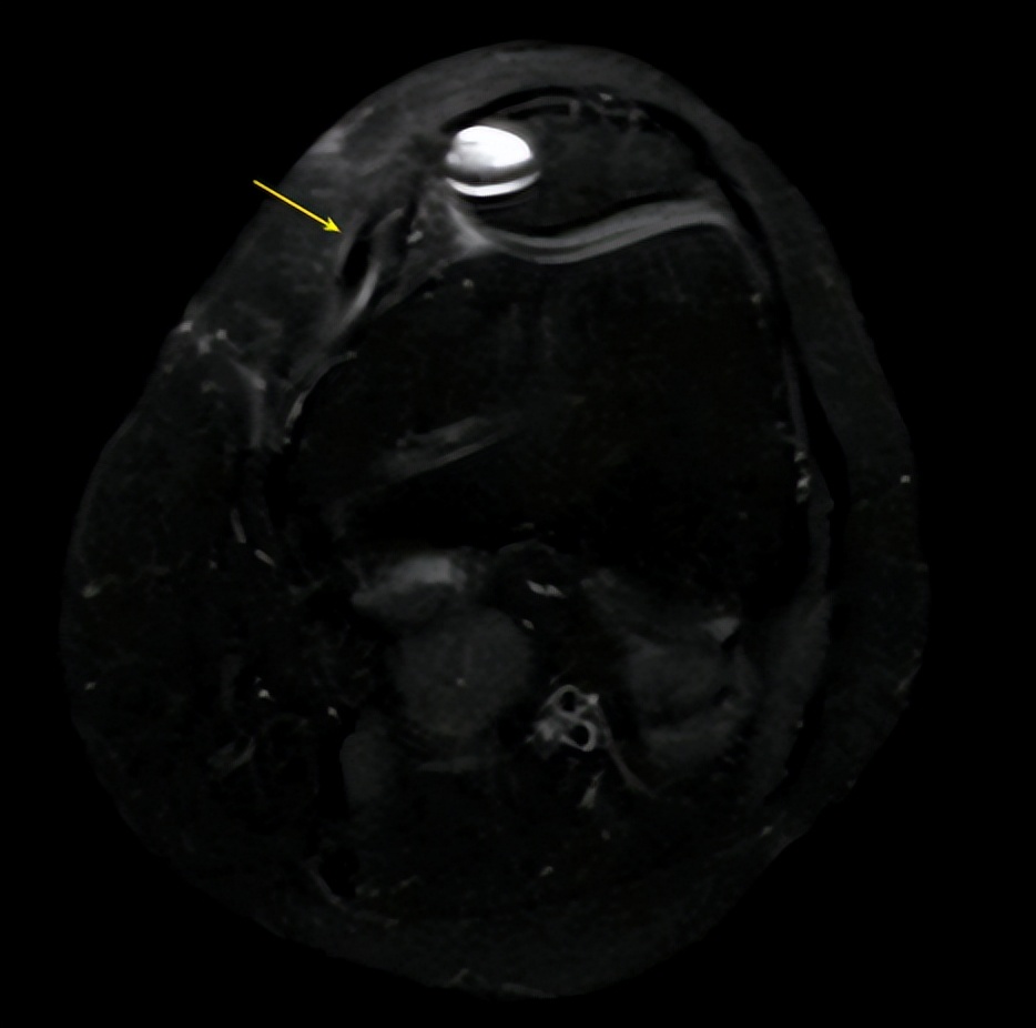 打羽毛球怎么防止肌腱断裂,打羽毛球韧带断裂