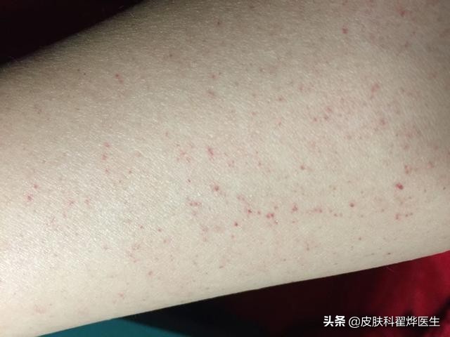 中老年人身上长红痣怎么回事,身上长了好几颗红痣一样的小点
