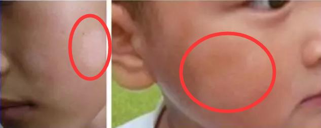 孩子脸上有白斑吃什么打虫药,小孩子脸上长白斑需要吃打虫药吗