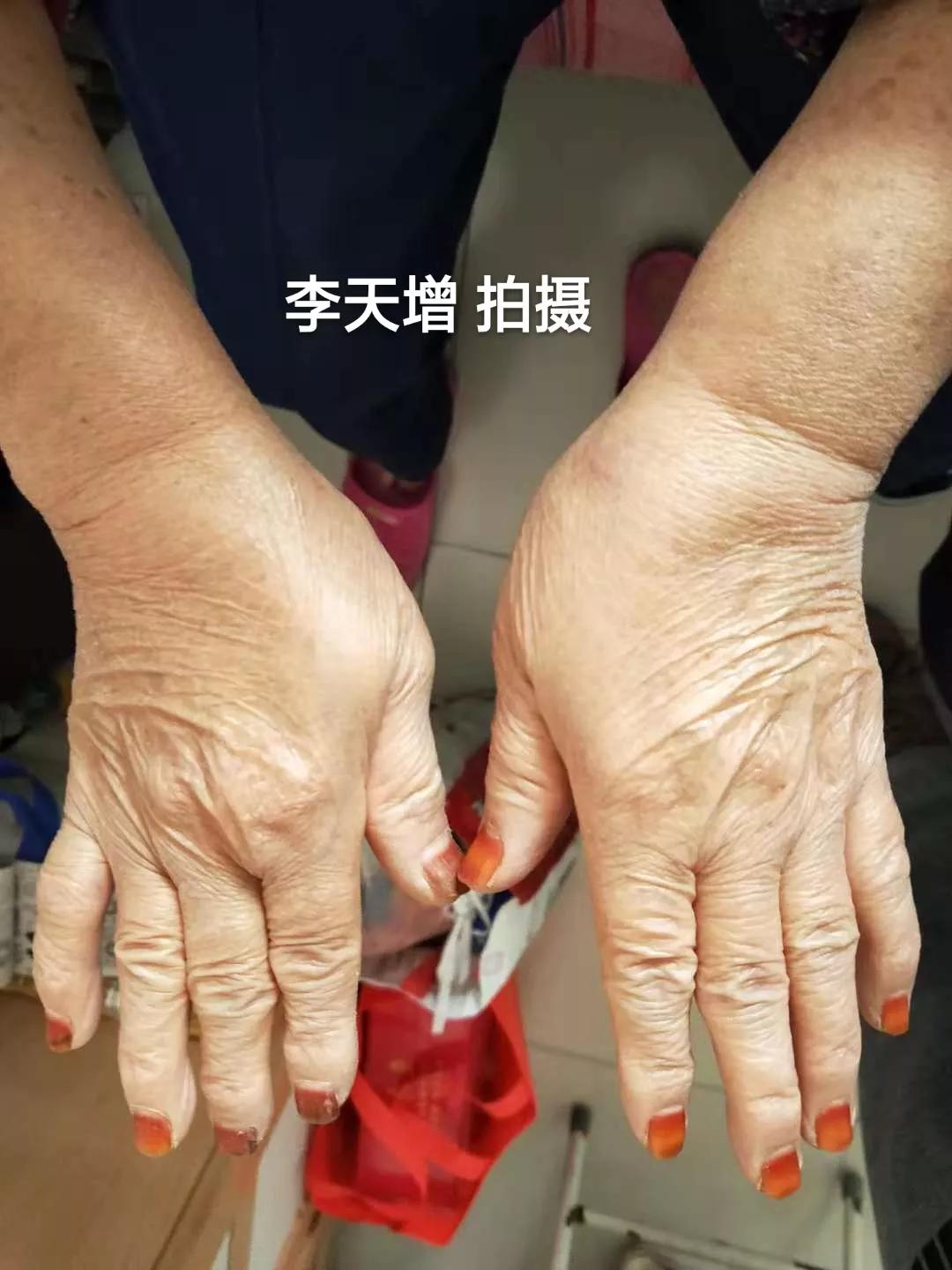 40岁女性手背开始很多皱纹怎么办,手背皮肤松弛皱纹多粗糙是啥原因