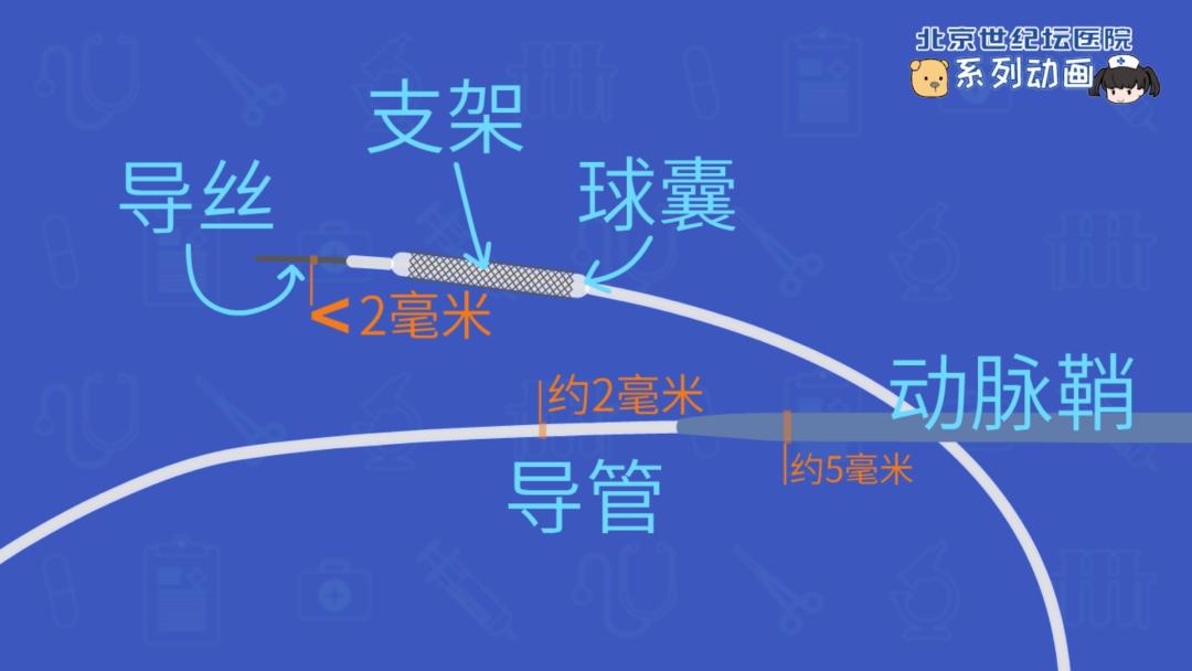 做完介入球囊扩张术后注意什么,冠心病介入术后随访卡的意义