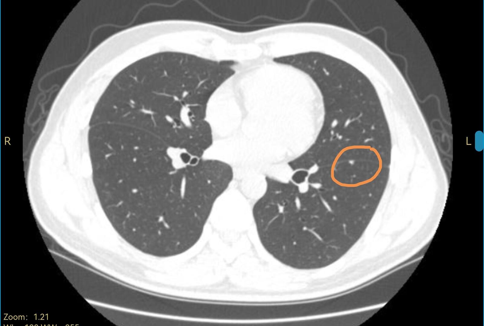 刘懿博士说肺癌的书,刘懿博士说肺癌全集