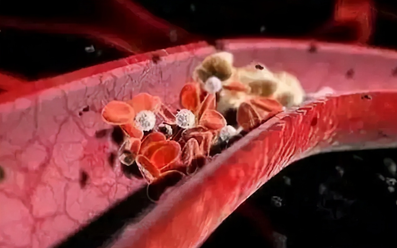 过敏性紫癜肾炎忌口食物有哪些,过敏性紫癜症状消失还要忌口吗