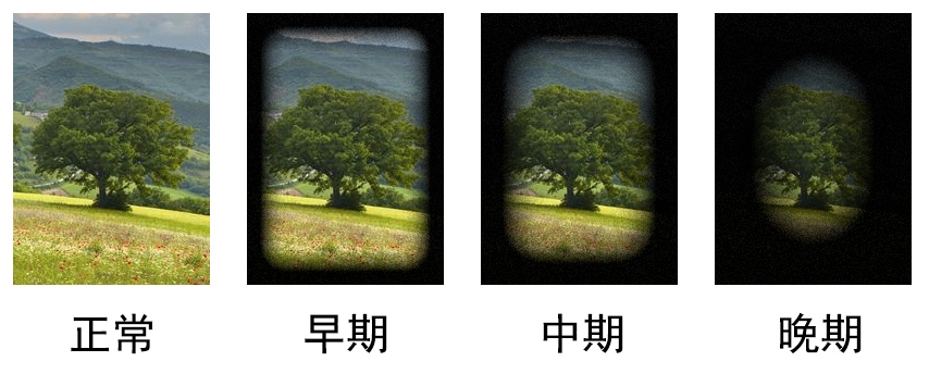 青光眼常被称为偷走视力的窃贼,世界青光眼日警惕沉默的视力窃贼