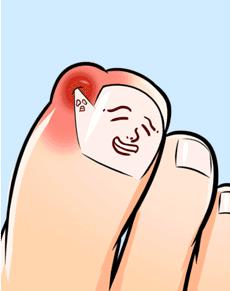 一走路脚趾甲里疼怎么回事,甲沟炎拔完脚趾甲很疼怎么办
