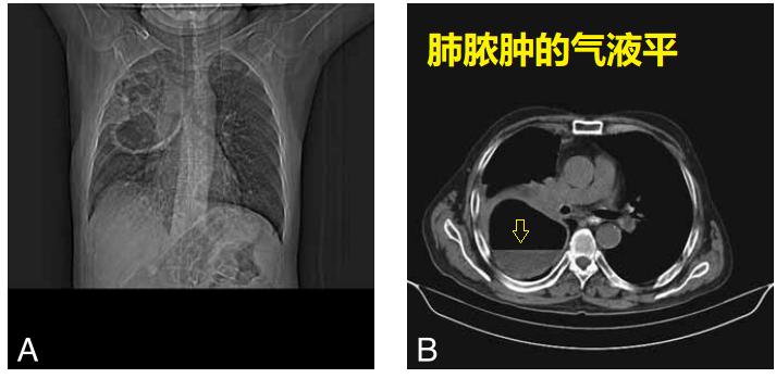 肺脓肿导管引流,肺脓肿的引流管脱落怎么办
