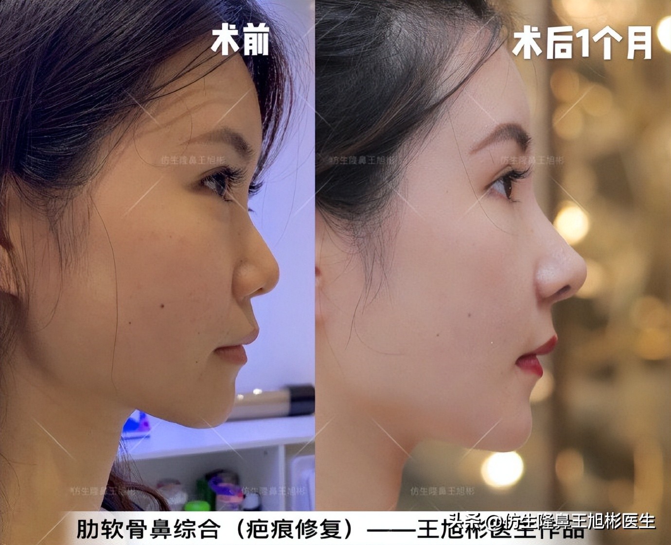 大鼻头能做直鼻微翘吗,可以只做鼻头缩小术吗