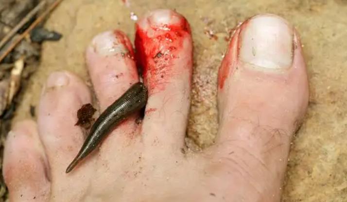 男孩喝生水取出蚂蟥,云南5岁男孩取出蚂蝗