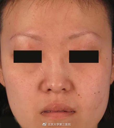 意外留疤怎么安慰,眉尾意外受伤留疤好不好