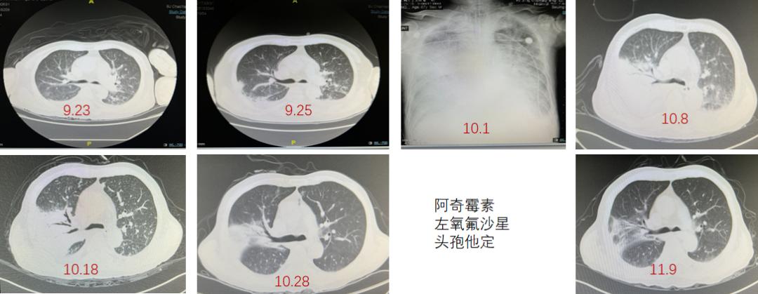 免疫缺陷病会并发什么病,什么是免疫缺陷肺部感染