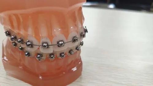 带上牙套后要做的事,戴了牙套一定要知道的事