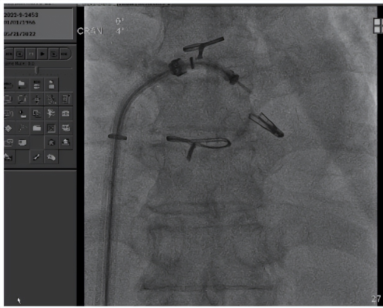 郑州大学第一附属医院心脏瓣膜,新技术治疗心脏瓣膜病