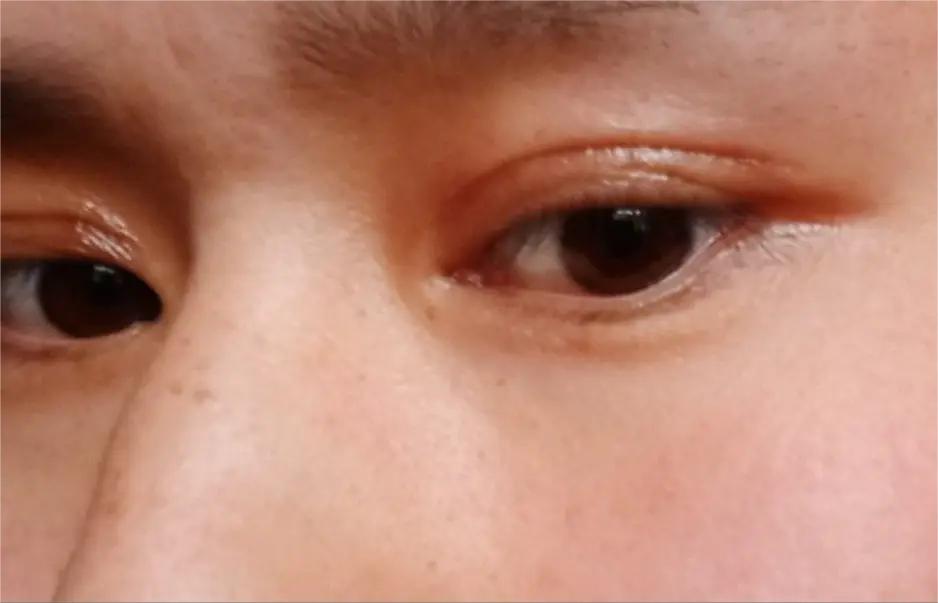 双眼皮术后眼头紧绷有细纹,双眼皮术后很多疤痕怎么办