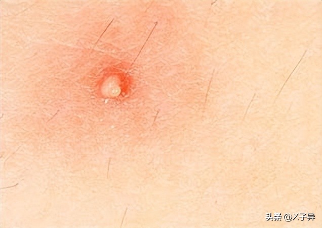 脸上长痘怎么办最快的方法,12岁女孩脸上长痘怎么消除