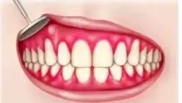 口腔牙龈内壁长硬包是上火吗,牙龈肿痛上火有个脓包怎么办