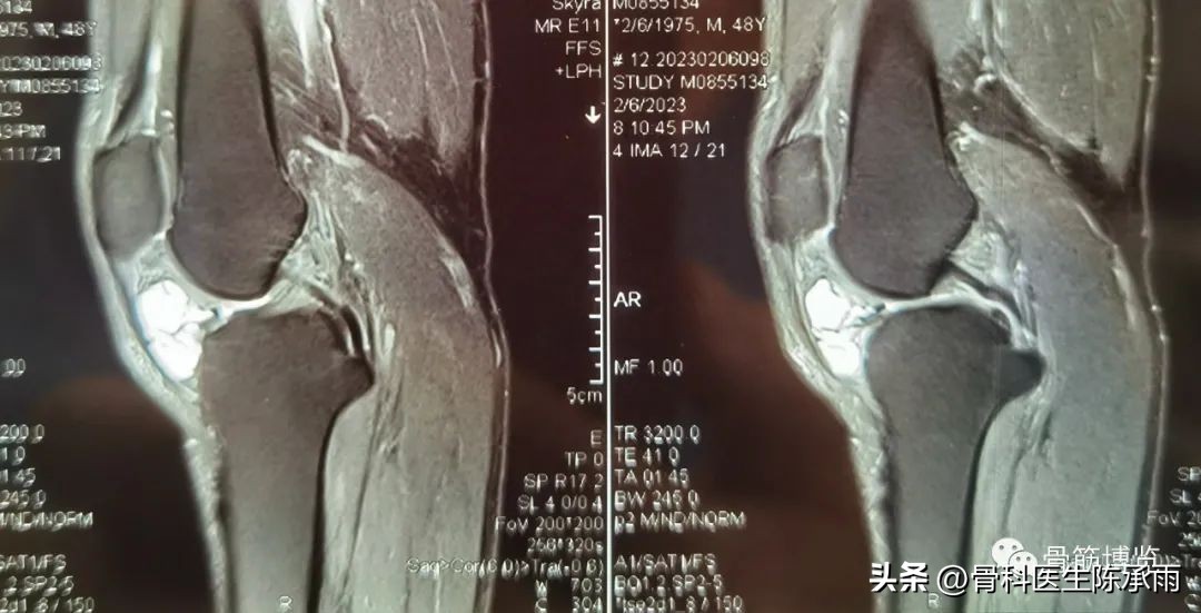 内侧半月板前角囊肿,关节镜下内侧半月板部分切除术