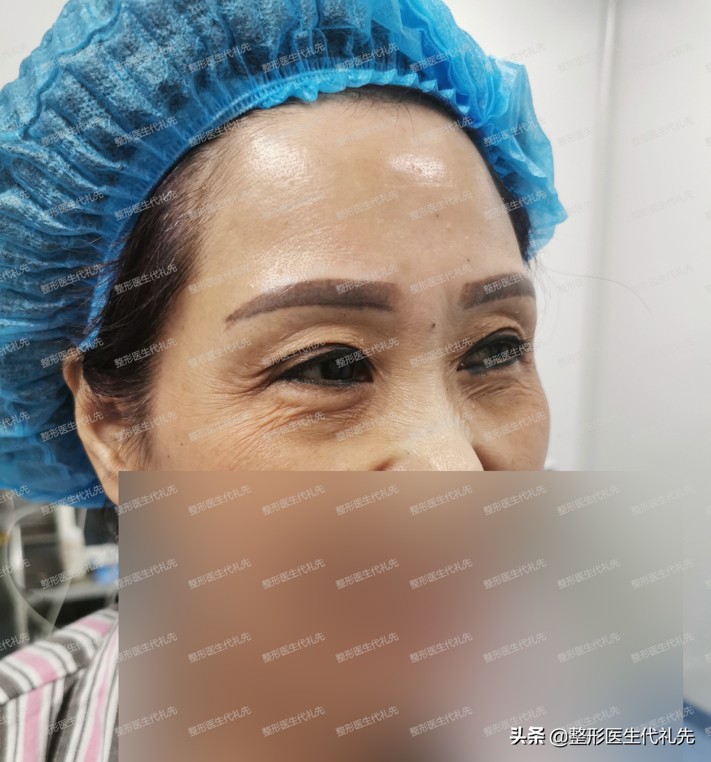 眼窝凹陷做了眼综合恢复,内双肿眼泡眼窝凹陷怎么手术