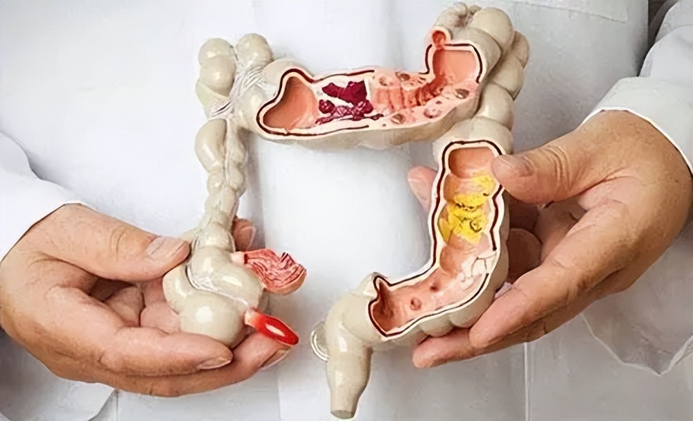 老年人结直肠癌患者危险因素及应用加速康复外科的临床治疗如何？