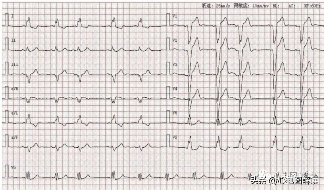 II、III、aVF导联的正常q波、异常Q波