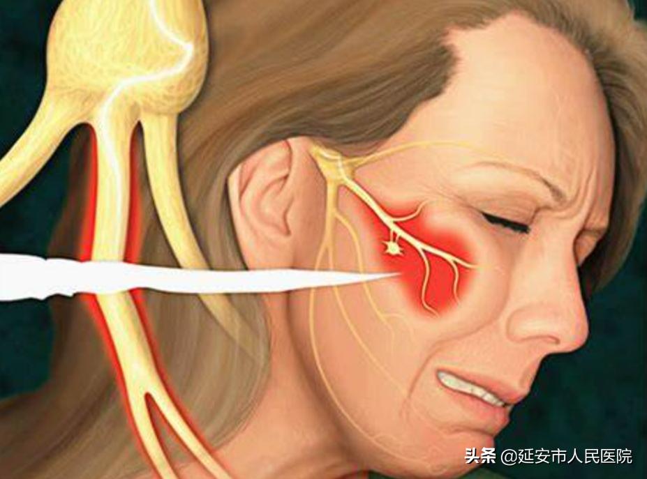 延安市人民医院疼痛康复科成功开展射频热凝术治疗三叉神经痛