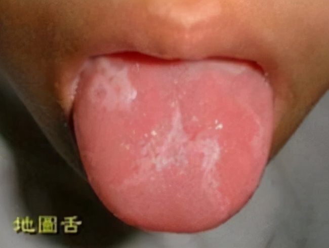 地图舌头要不要治疗,地图舌头的治疗方法