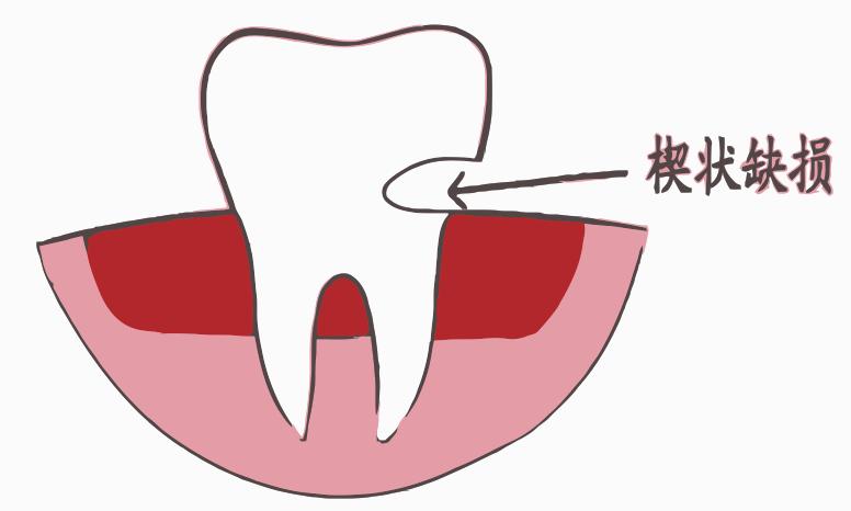 楔状缺损不补牙会恶化吗,楔状缺损最好的治疗方案