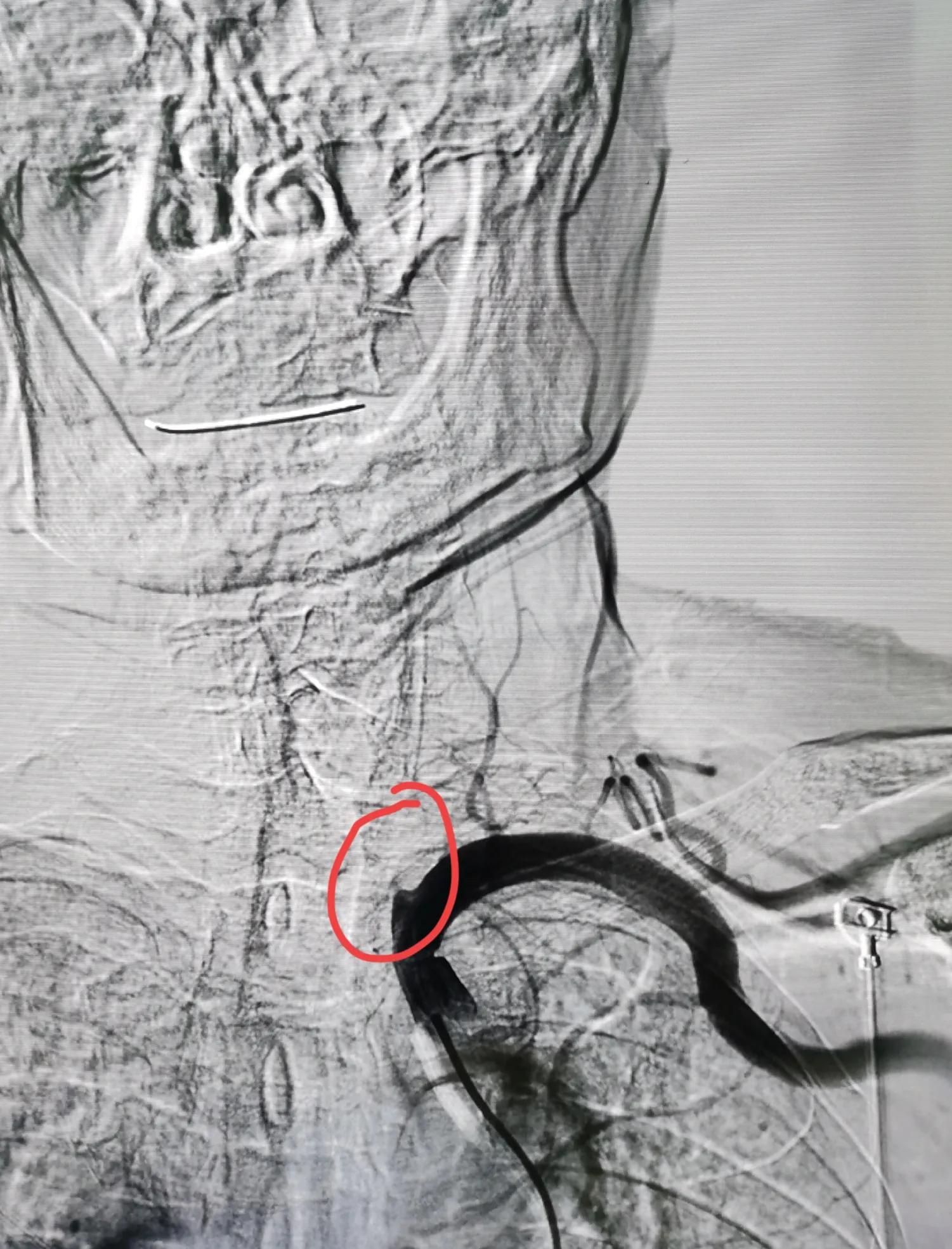 一例头痛头晕患者个案护理,患者出现头晕一侧眼睛看不清