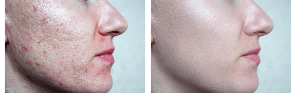 痘痘和痘坑痘印怎么祛,还在为痘疤烦恼赶紧试试这些方法