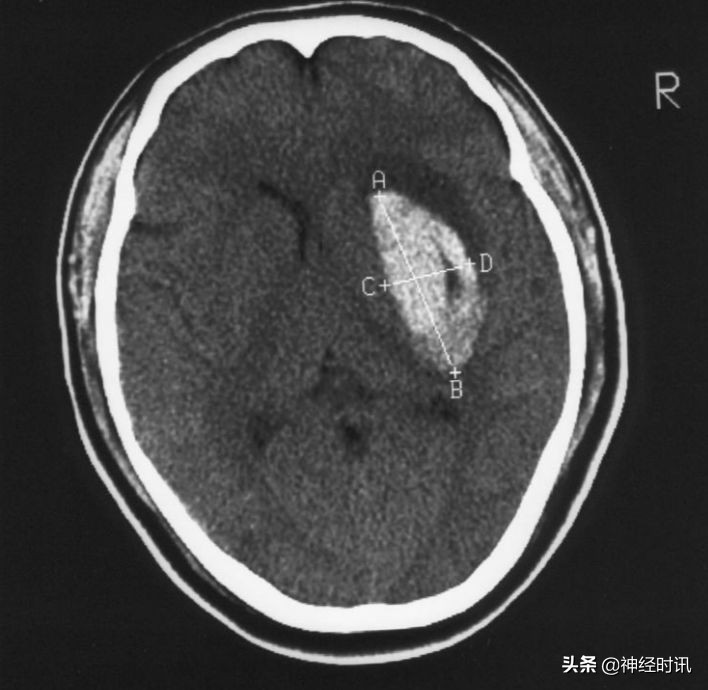 脑受撞击少量出血症状表现,脑动脉瘤出血的表现