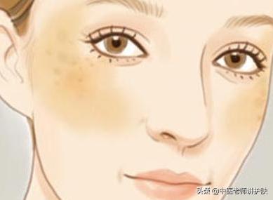 色斑也得分类别,从中医角度浅谈色斑成因,这样治疗更有效