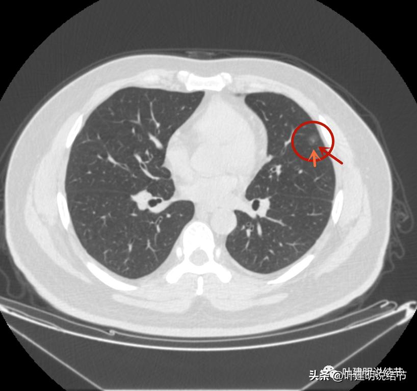 如何判断肺磨玻璃结节是高危结节,肺上有混合磨玻璃结节要注意什么