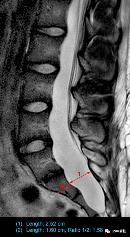 硬膜扩张,duralectasia
