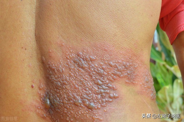 嘴唇起泡是细菌感染还是病毒,嘴唇起水泡一般是什么病毒感染的