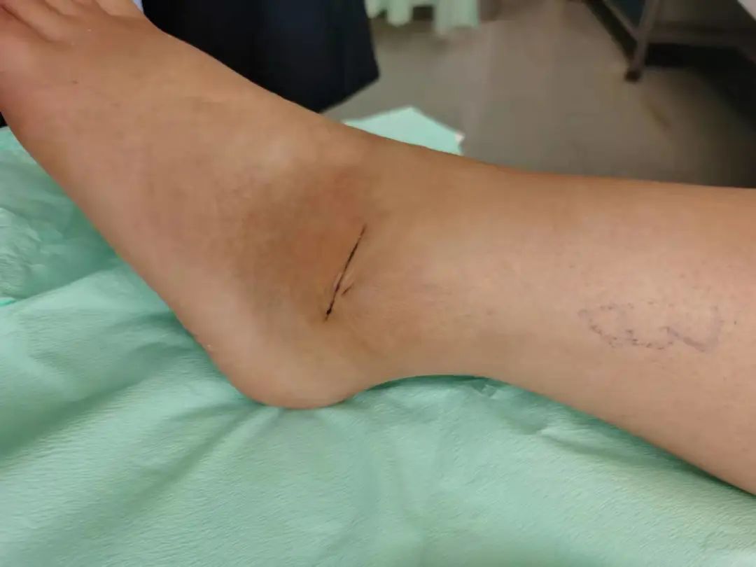 踝关节韧带修复后还会断吗,踝关节韧带修复手术有疤痕吗